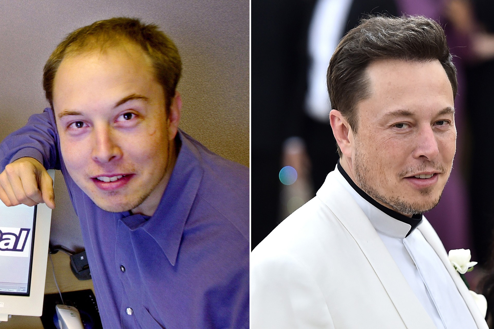 Elon Musk Hair Transplant: Facts and Details
